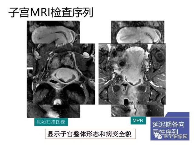 【PPT】女性盆腔肿瘤的MR成像技术与诊断思路