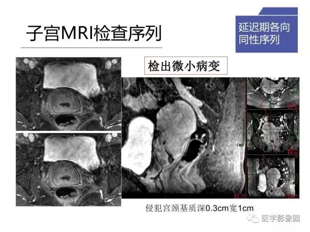 【PPT】女性盆腔肿瘤的MR成像技术与诊断思路