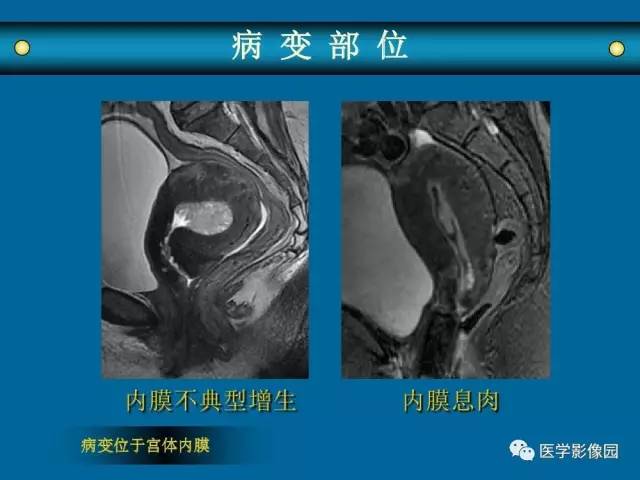 【PPT】女性盆腔肿瘤的MR成像技术与诊断思路