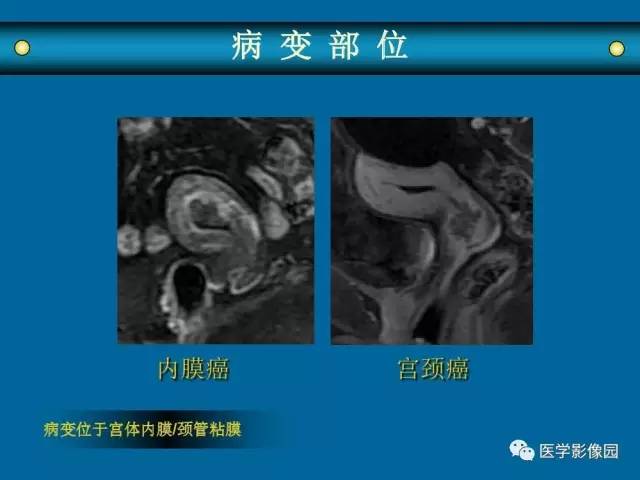【PPT】女性盆腔肿瘤的MR成像技术与诊断思路
