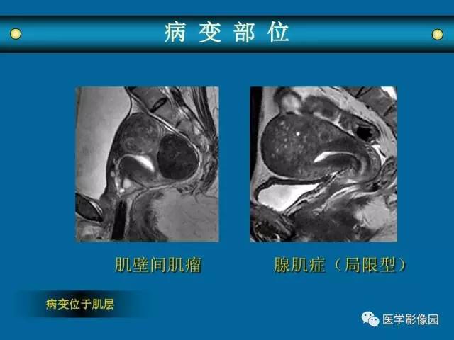 【PPT】女性盆腔肿瘤的MR成像技术与诊断思路