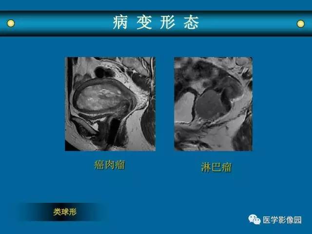 【PPT】女性盆腔肿瘤的MR成像技术与诊断思路