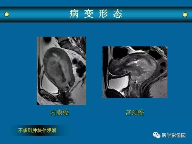 【PPT】女性盆腔肿瘤的MR成像技术与诊断思路