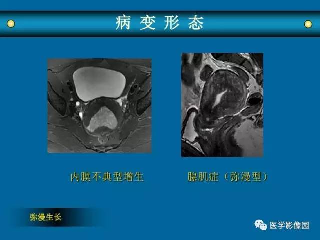 【PPT】女性盆腔肿瘤的MR成像技术与诊断思路