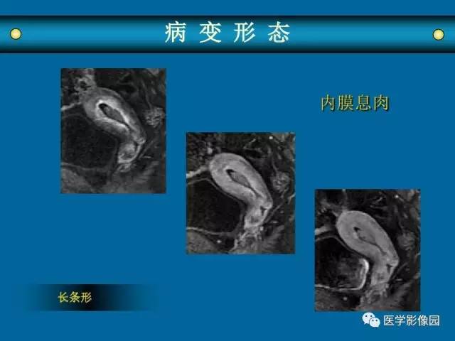【PPT】女性盆腔肿瘤的MR成像技术与诊断思路