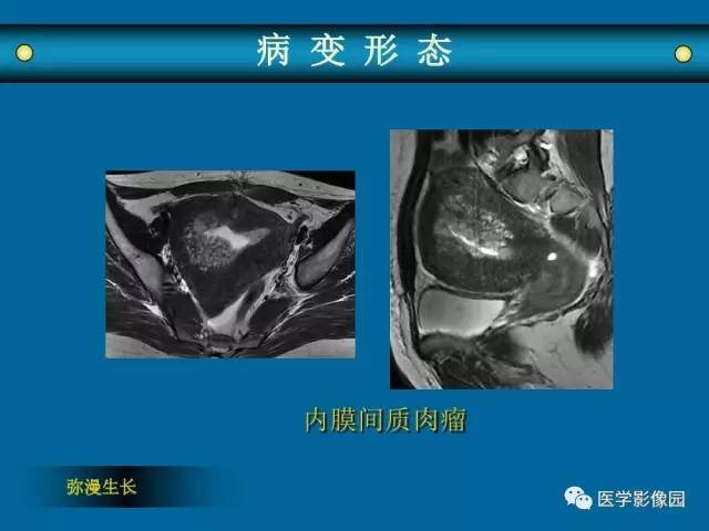 【PPT】女性盆腔肿瘤的MR成像技术与诊断思路