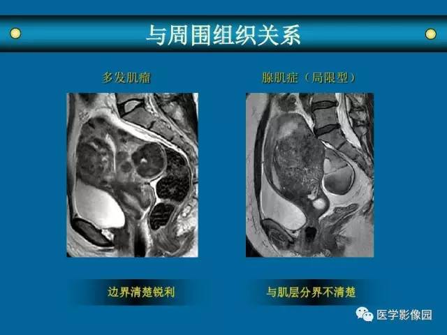 【PPT】女性盆腔肿瘤的MR成像技术与诊断思路