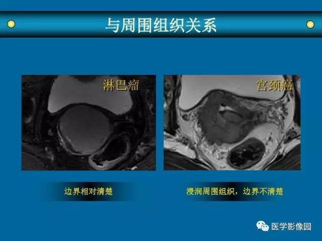 【PPT】女性盆腔肿瘤的MR成像技术与诊断思路