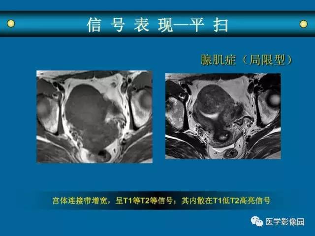 【PPT】女性盆腔肿瘤的MR成像技术与诊断思路