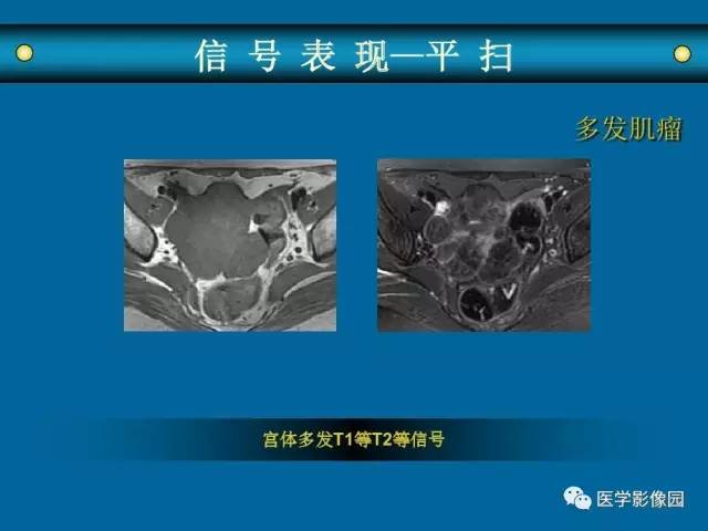 【PPT】女性盆腔肿瘤的MR成像技术与诊断思路