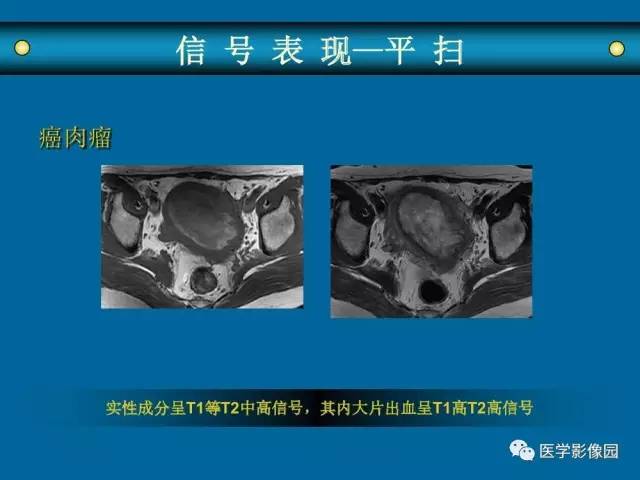 【PPT】女性盆腔肿瘤的MR成像技术与诊断思路