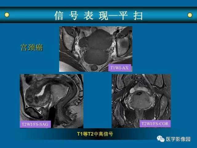 【PPT】女性盆腔肿瘤的MR成像技术与诊断思路