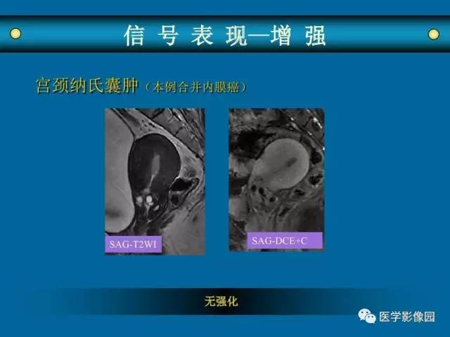 【PPT】女性盆腔肿瘤的MR成像技术与诊断思路
