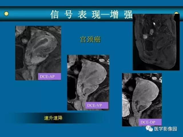 【PPT】女性盆腔肿瘤的MR成像技术与诊断思路