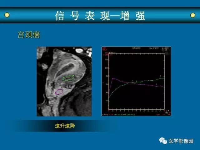 【PPT】女性盆腔肿瘤的MR成像技术与诊断思路