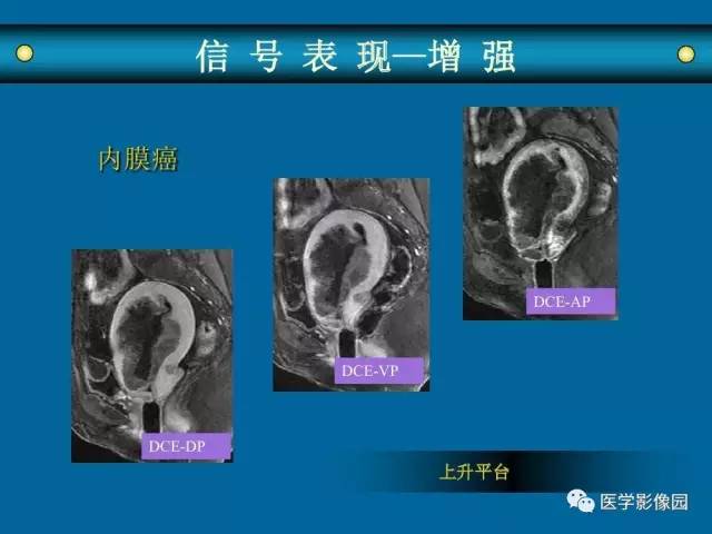 【PPT】女性盆腔肿瘤的MR成像技术与诊断思路