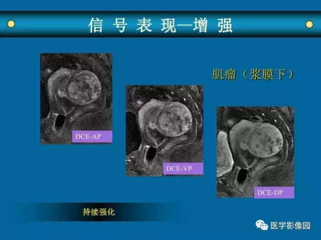 【PPT】女性盆腔肿瘤的MR成像技术与诊断思路