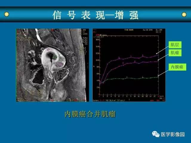 【PPT】女性盆腔肿瘤的MR成像技术与诊断思路
