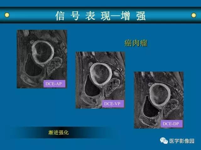 【PPT】女性盆腔肿瘤的MR成像技术与诊断思路