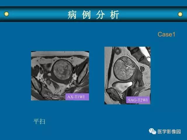 【PPT】女性盆腔肿瘤的MR成像技术与诊断思路