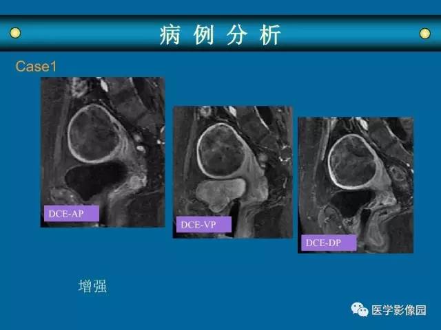 【PPT】女性盆腔肿瘤的MR成像技术与诊断思路