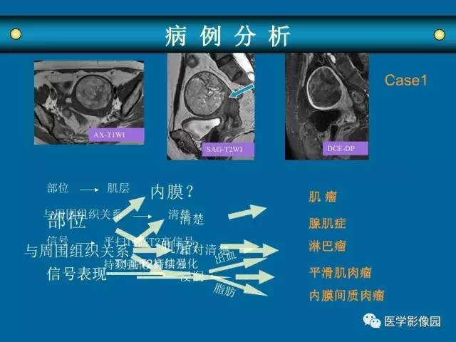 【PPT】女性盆腔肿瘤的MR成像技术与诊断思路