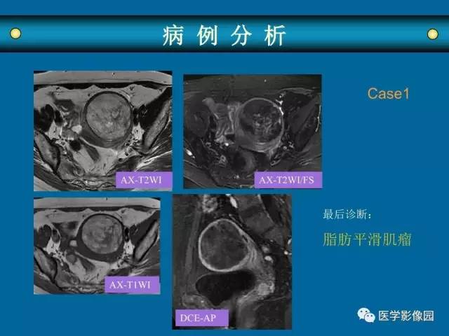 【PPT】女性盆腔肿瘤的MR成像技术与诊断思路