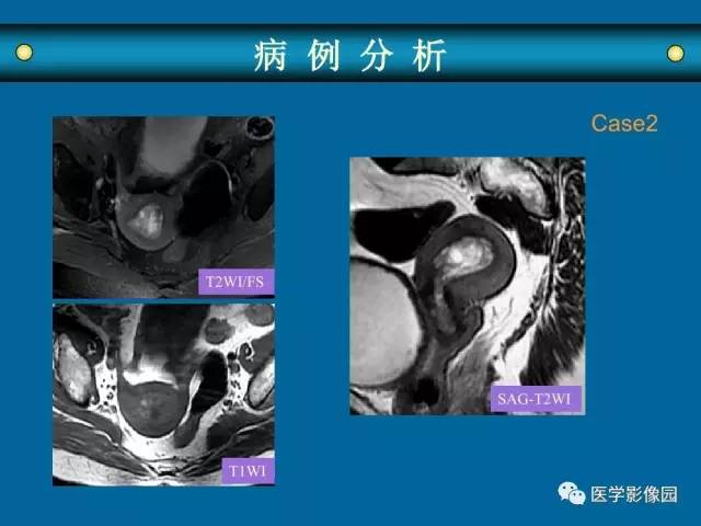 【PPT】女性盆腔肿瘤的MR成像技术与诊断思路