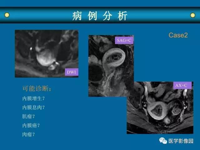 【PPT】女性盆腔肿瘤的MR成像技术与诊断思路