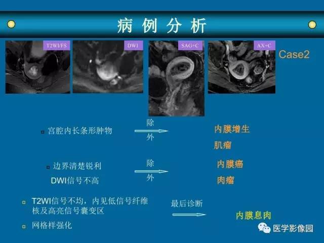 【PPT】女性盆腔肿瘤的MR成像技术与诊断思路