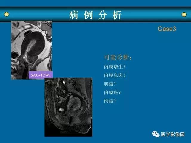 【PPT】女性盆腔肿瘤的MR成像技术与诊断思路