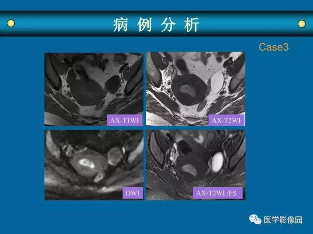 【PPT】女性盆腔肿瘤的MR成像技术与诊断思路
