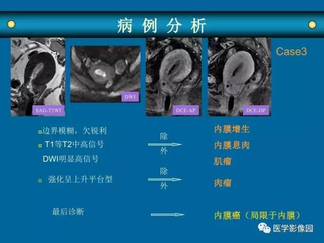 【PPT】女性盆腔肿瘤的MR成像技术与诊断思路