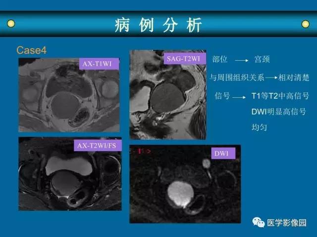 【PPT】女性盆腔肿瘤的MR成像技术与诊断思路