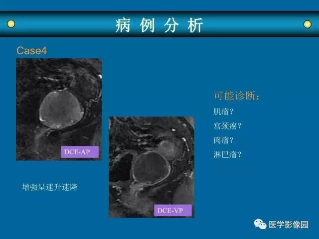 【PPT】女性盆腔肿瘤的MR成像技术与诊断思路