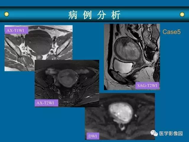 【PPT】女性盆腔肿瘤的MR成像技术与诊断思路