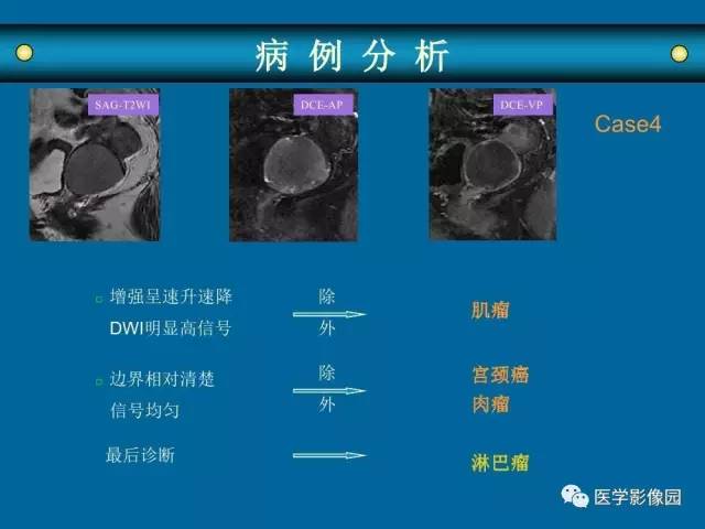 【PPT】女性盆腔肿瘤的MR成像技术与诊断思路
