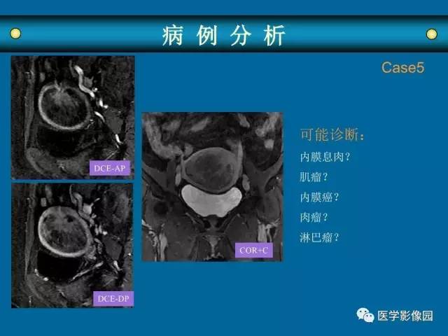 【PPT】女性盆腔肿瘤的MR成像技术与诊断思路