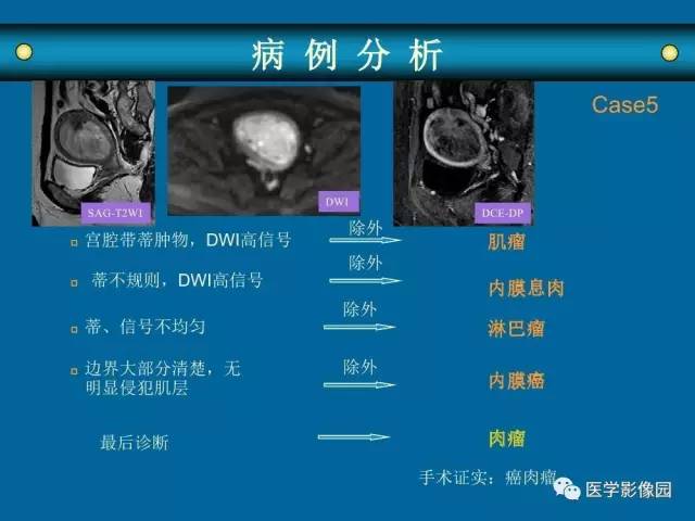 【PPT】女性盆腔肿瘤的MR成像技术与诊断思路