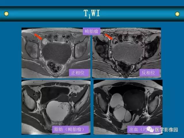 【PPT】女性盆腔肿瘤的MR成像技术与诊断思路