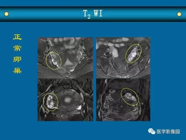 【PPT】女性盆腔肿瘤的MR成像技术与诊断思路