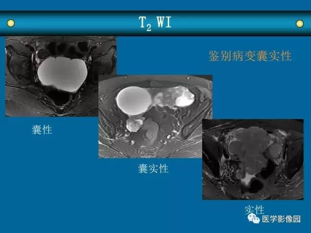 【PPT】女性盆腔肿瘤的MR成像技术与诊断思路
