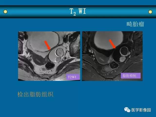 【PPT】女性盆腔肿瘤的MR成像技术与诊断思路