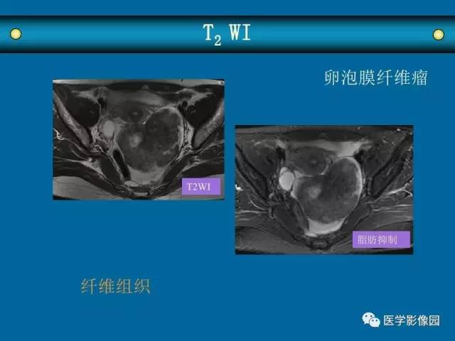 【PPT】女性盆腔肿瘤的MR成像技术与诊断思路