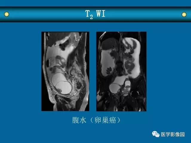 【PPT】女性盆腔肿瘤的MR成像技术与诊断思路