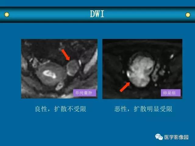 【PPT】女性盆腔肿瘤的MR成像技术与诊断思路