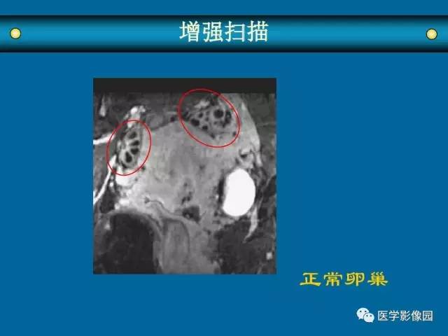【PPT】女性盆腔肿瘤的MR成像技术与诊断思路