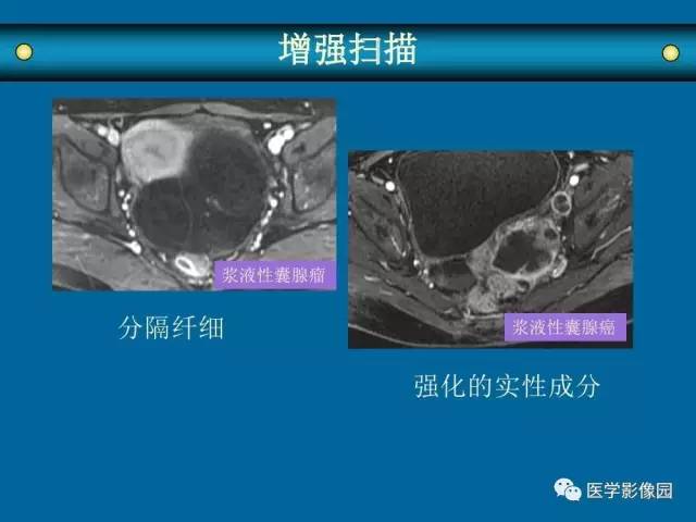 【PPT】女性盆腔肿瘤的MR成像技术与诊断思路