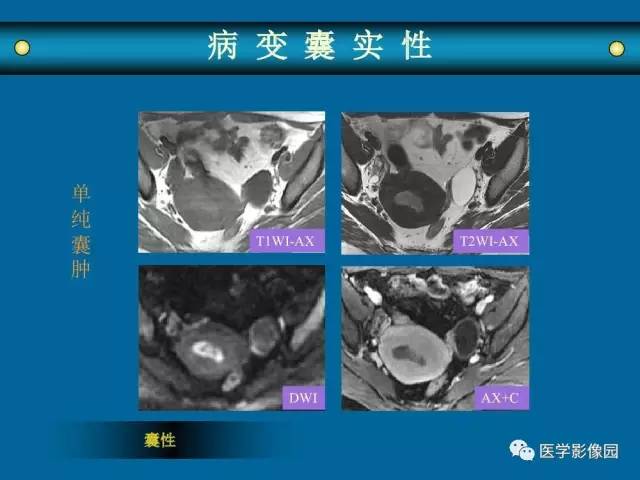 【PPT】女性盆腔肿瘤的MR成像技术与诊断思路