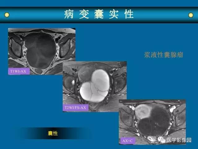 【PPT】女性盆腔肿瘤的MR成像技术与诊断思路
